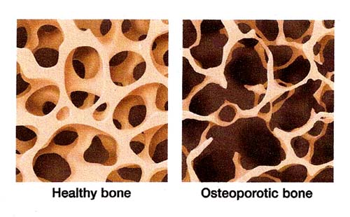 This image shows the side-by-side comparison of a healthy bone compared to a bone affected by osteoporosis.